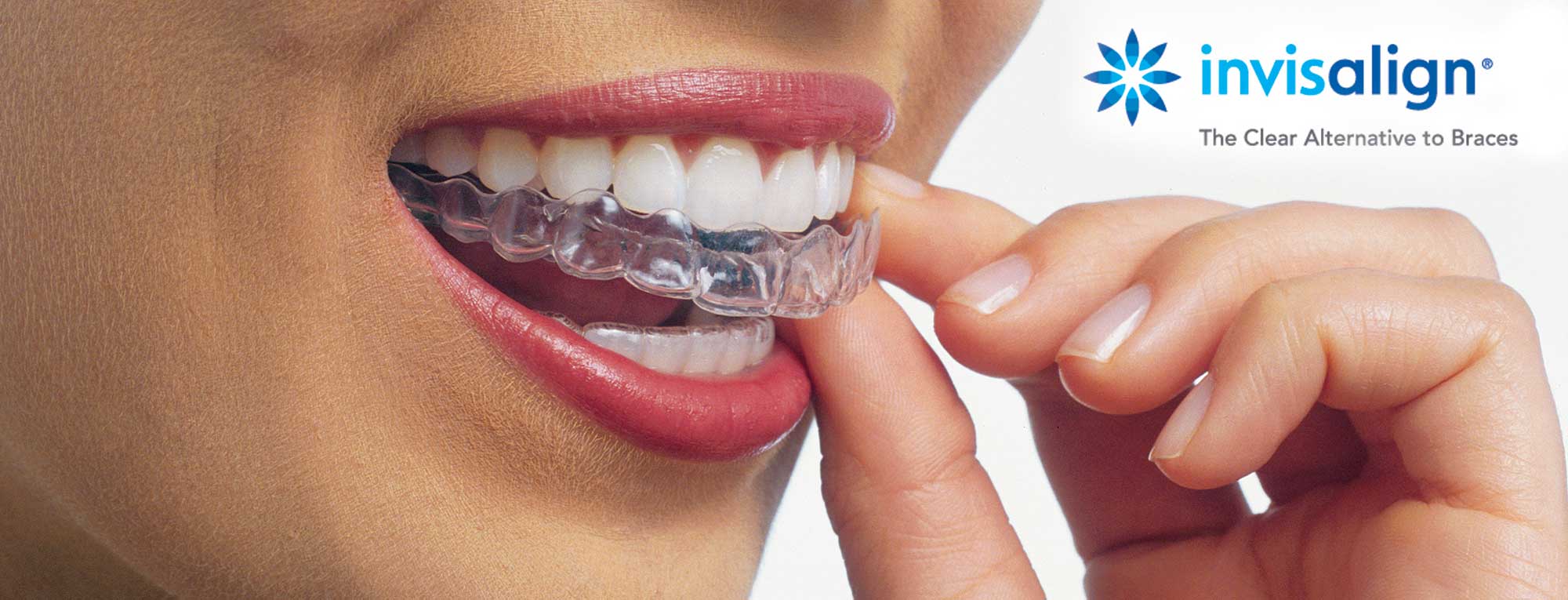 ortodoncia invisible invisalign 1 ortodoncia invisible invisalign 1