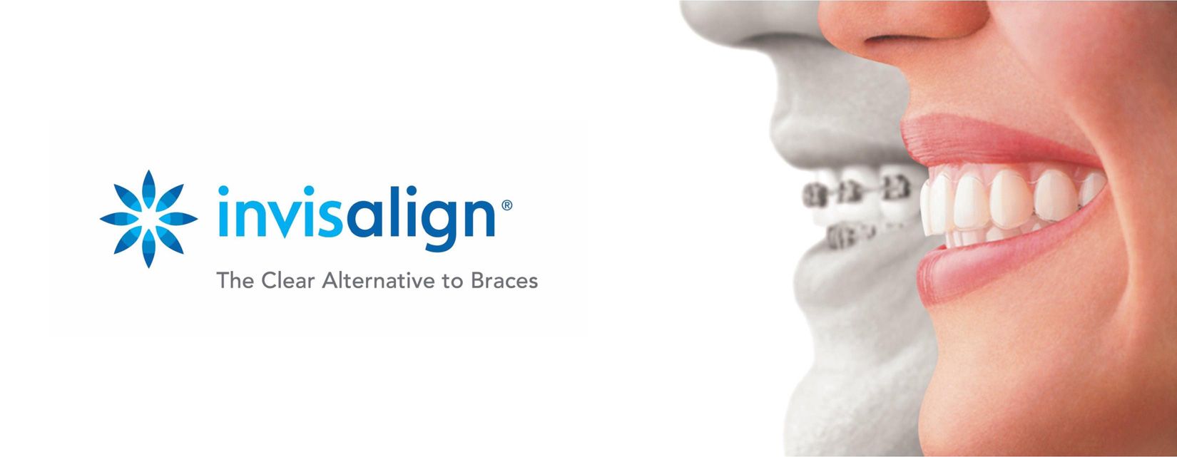 ortodoncia invisible invisalign 3 ortodoncia invisible invisalign 3