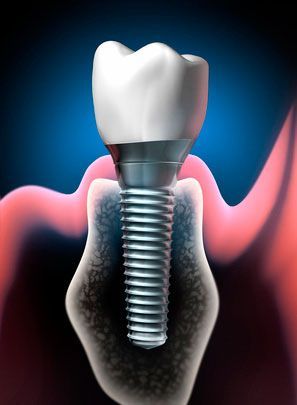 implantologia dental implantologia dental