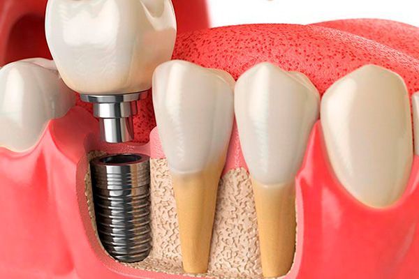 implantes
