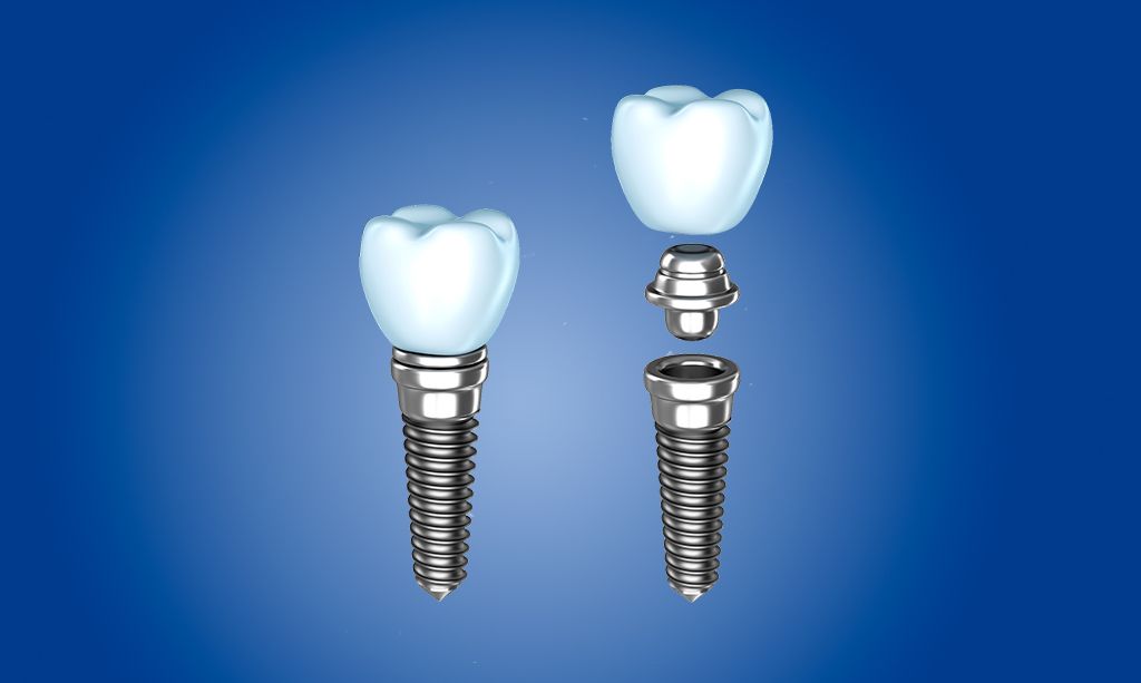 Los mejores implantes dentales en La Sagrera Barcelona Los mejores implantes dentales en La Sagrera Barcelona