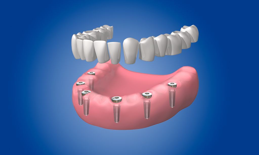 Dentaduras completas fijas en La Sagrera Barcelona Dentaduras completas fijas en La Sagrera Barcelona