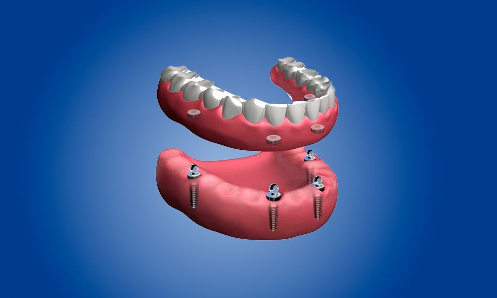 Dentaduras completas extraíbles en La Sagrera Barcelona Dentaduras completas extraíbles en La Sagrera Barcelona