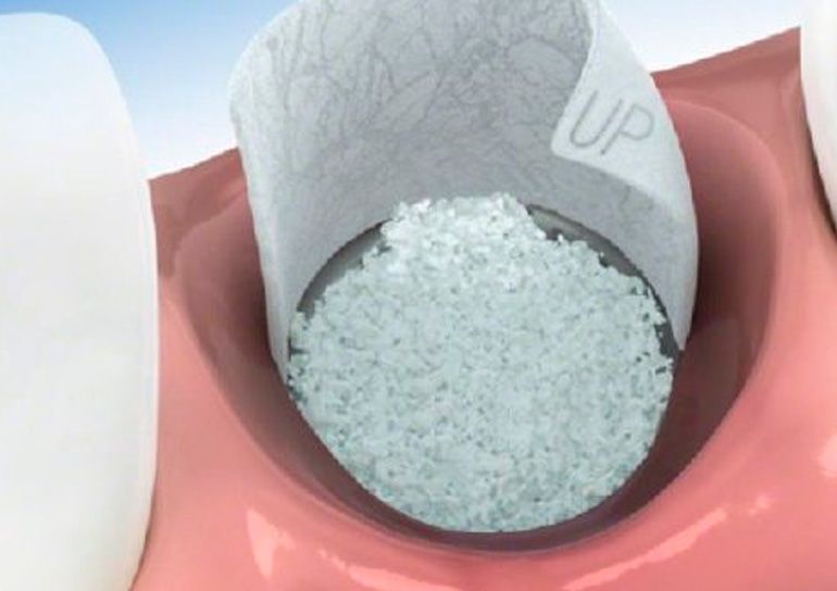 regeneracion osea Regeneración ósea Cuando es necesario podemos aplicar técnicas de regeneración ósea para recuperar parte del hueso perdido o para conseguir una correcta sujeción dental.