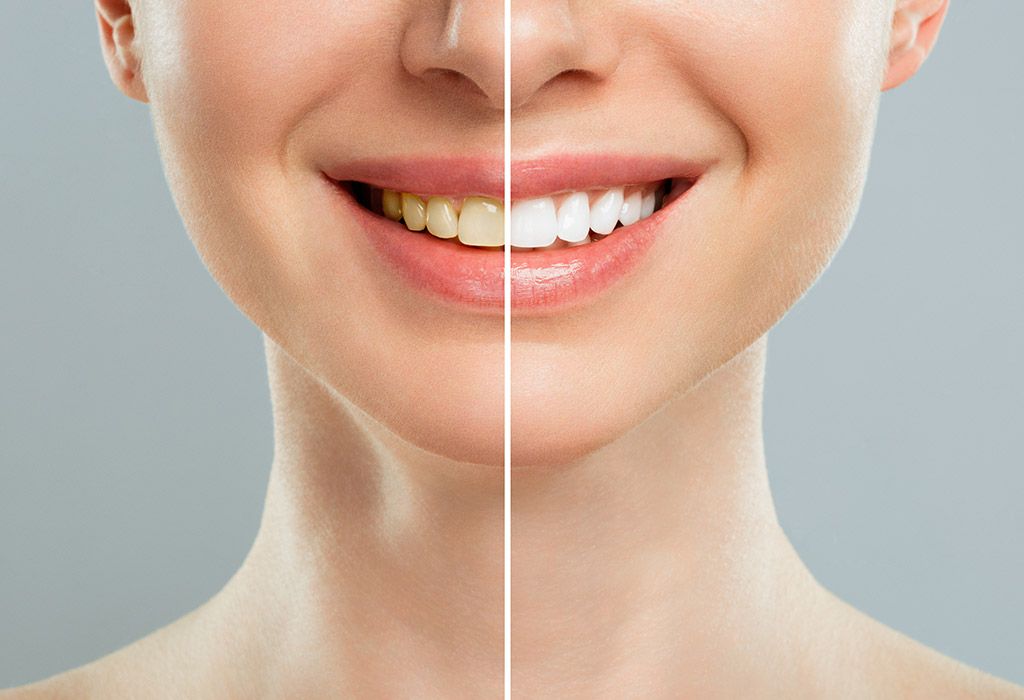 blanqueamiento dental en la sagrera barcelona