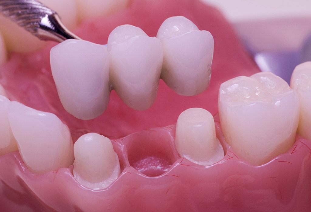 Prótesis dental fija en La Sagrera Prótesis dental fija en La Sagrera