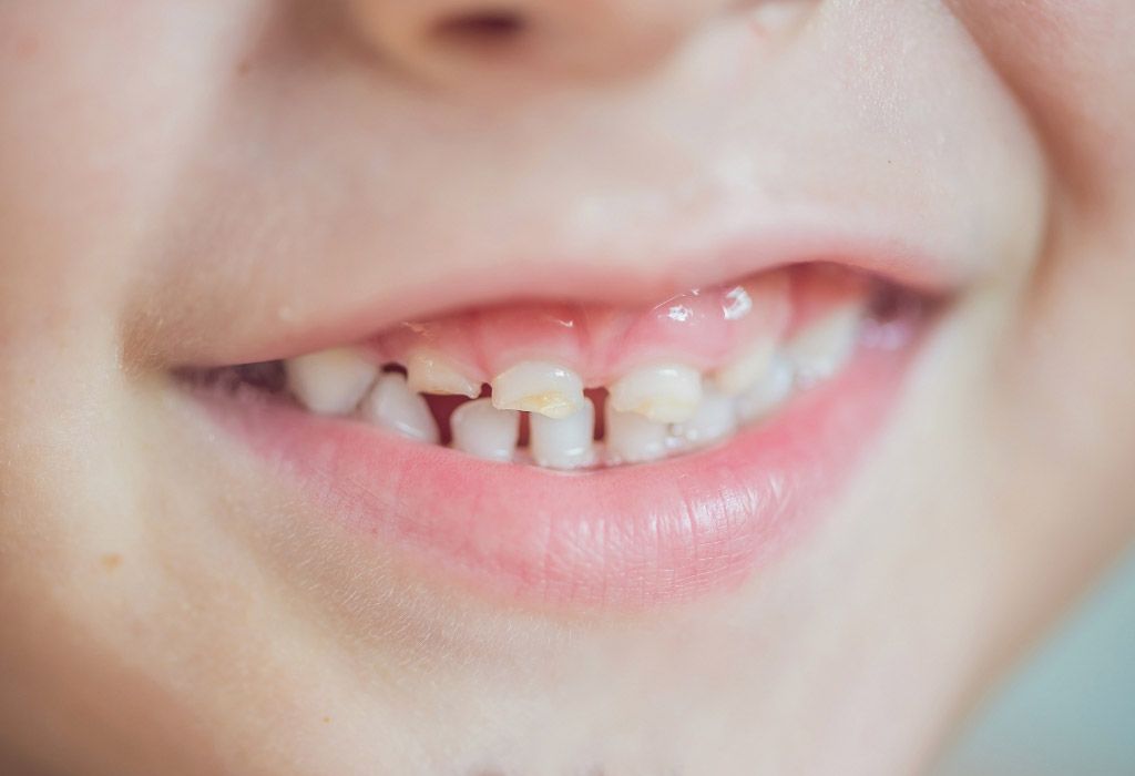 Extracciones de dientes de leche en Clinica Dental Blaudent Extracciones de dientes de leche en Clinica Dental Blaudent