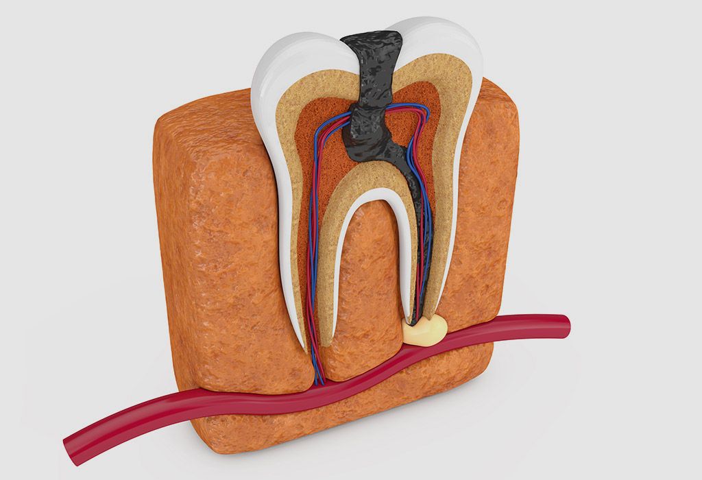 Endodoncia en La Sagrera: caries profundas