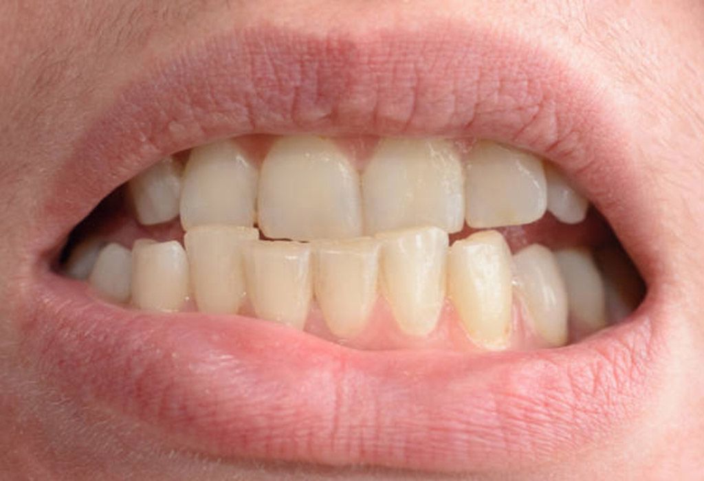 Endodoncia en La Sagrera: Desgaste dental excesivo