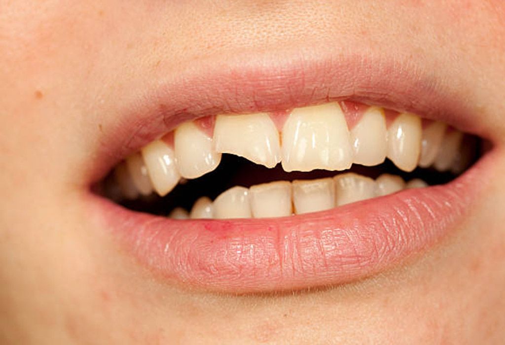 Endodoncia en La Sagrera: Fracturas o traumas dentales