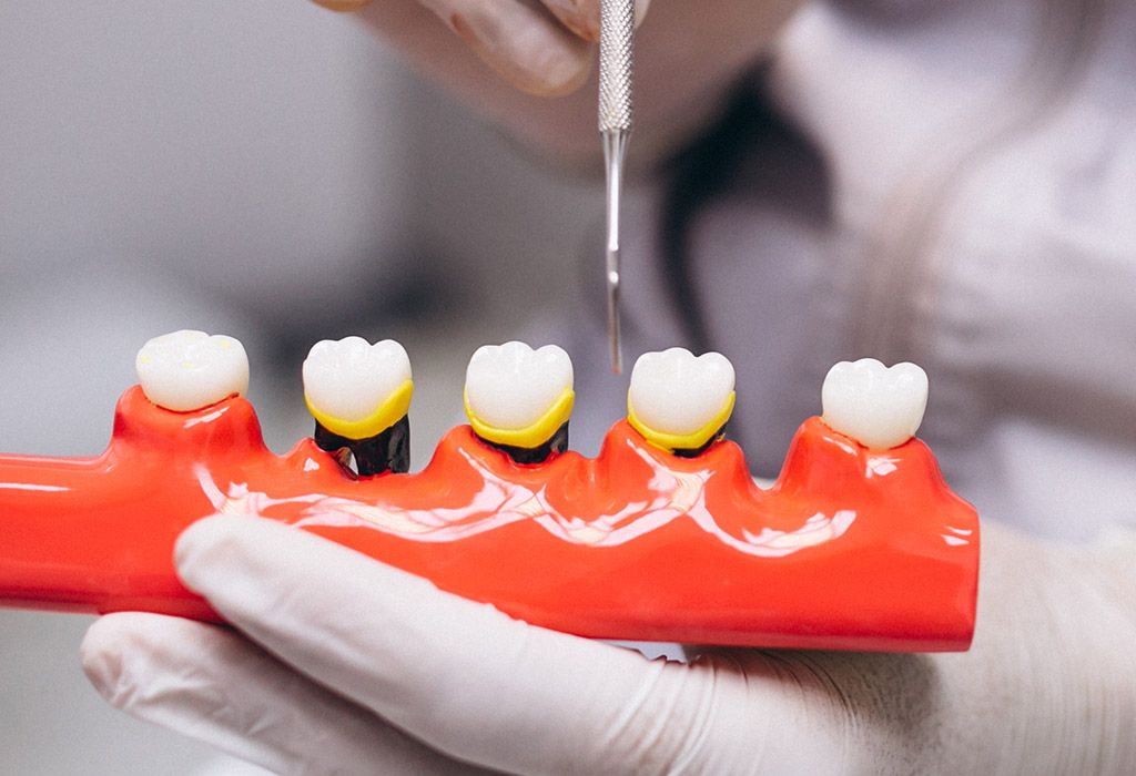 Endodoncia en La Sagrera: fallo de restauraciones dentales anteriores