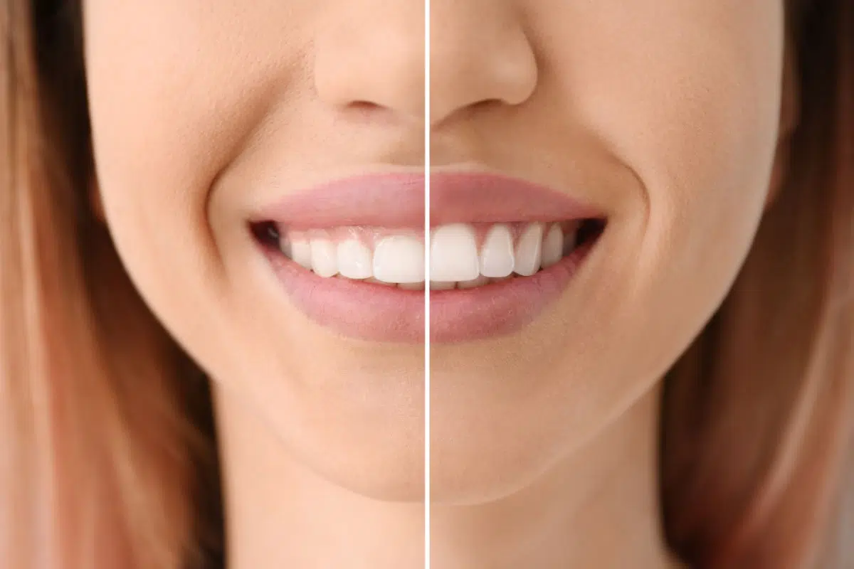 Gingivectomía y osteoplastia Gingivectomía y osteoplastia